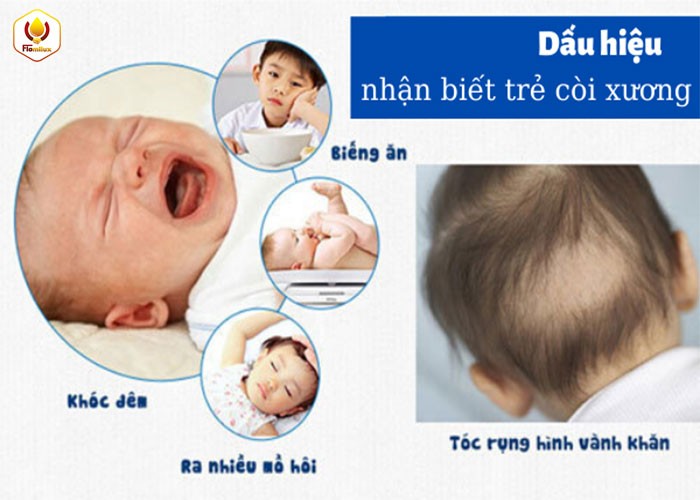 Các Dấu Hiệu Trẻ Bị Còi Xương Và Suy Dinh Dưỡng