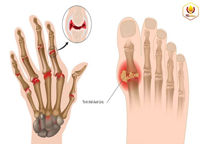 Nỗi đau bệnh xương khớp gây ra? Bệnh gout