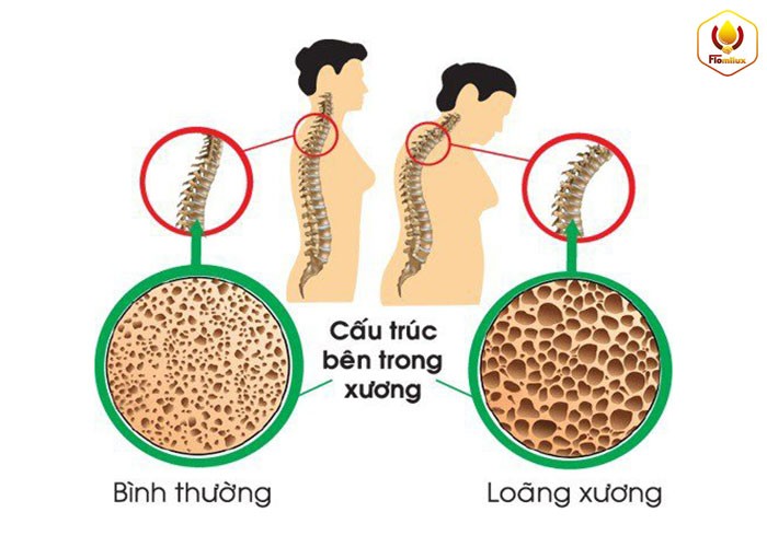 Bệnh loãng xương