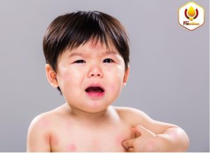 Dị ứng đạm Sữa Bò