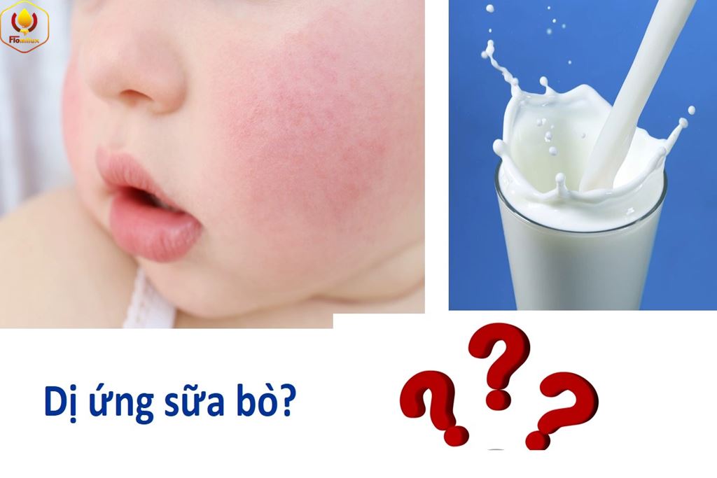 Dị ứng